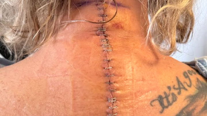 Support Pam’s Recovery from Major Spine Surgery campaign photo, 1 of 7