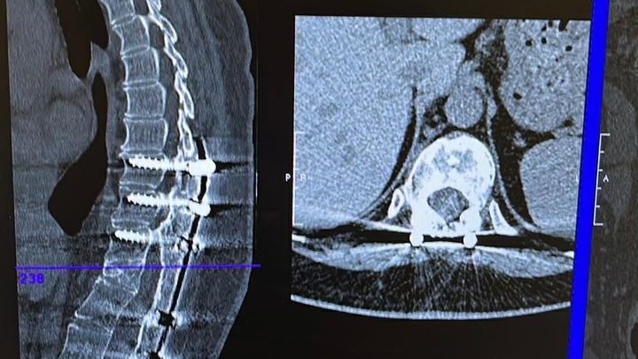 Help Allison Recover After Spinal Surgery campaign photo, 1 of 3