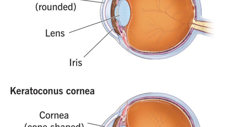 Support Her Eye Surgery and Recovery Costs campaign photo, 1 of 4