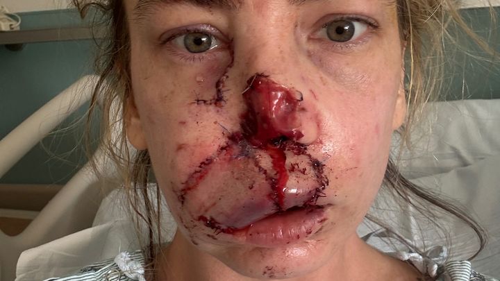 Support Heather's Healing After Dog Attack campaign photo, 1 of 8