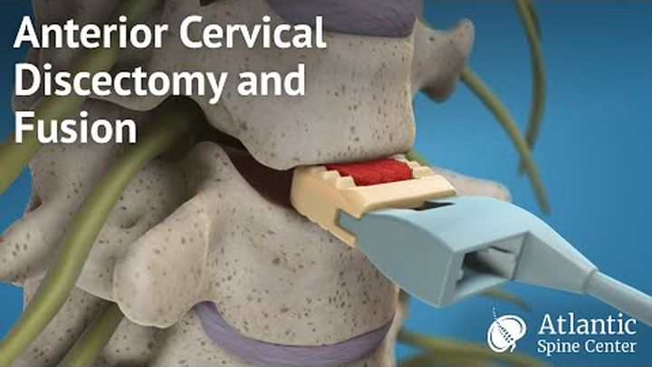 Leticia's ACDF Surgery & Recovery Support video thumbnail, 1 of 6