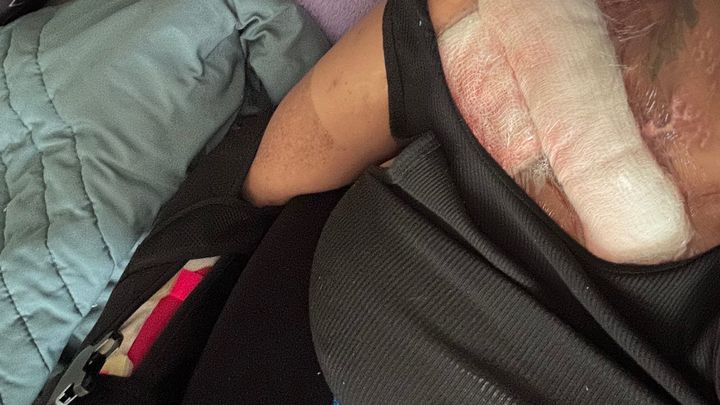 Help Tee Recover After Firework Accident campaign photo, 1 of 3
