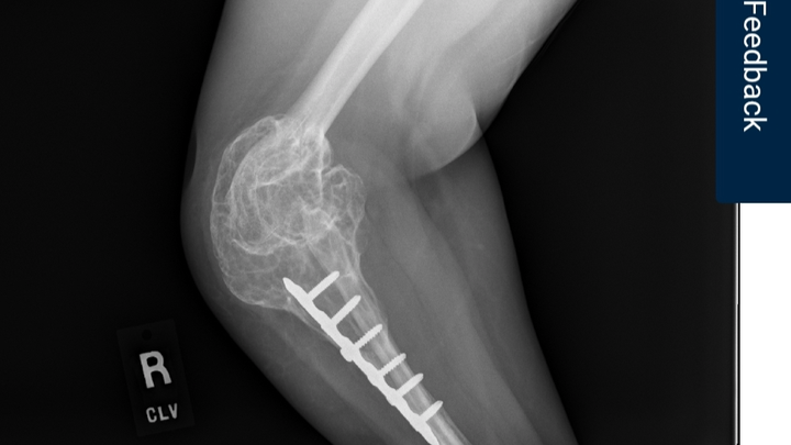 Support Julia's Elbow Surgery Recovery campaign photo, 1 of 5