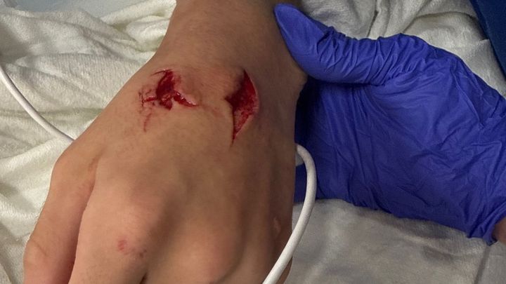 Support Dominick’s Recovery After Beaver Attack campaign photo, 1 of 6