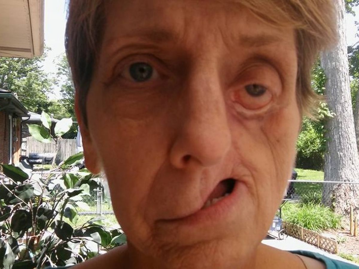 Laura's reconstructive surgery campaign photo, 1 of 3