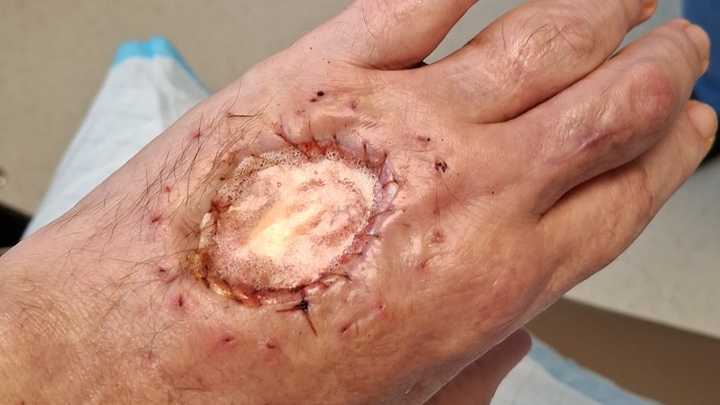 Support for Daniel's Recovery After Opossum Bite campaign photo, 1 of 8