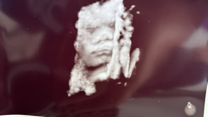 Baby Manywhitehorses Vein of Galen Malformation Fund campaign photo, 1 of 3