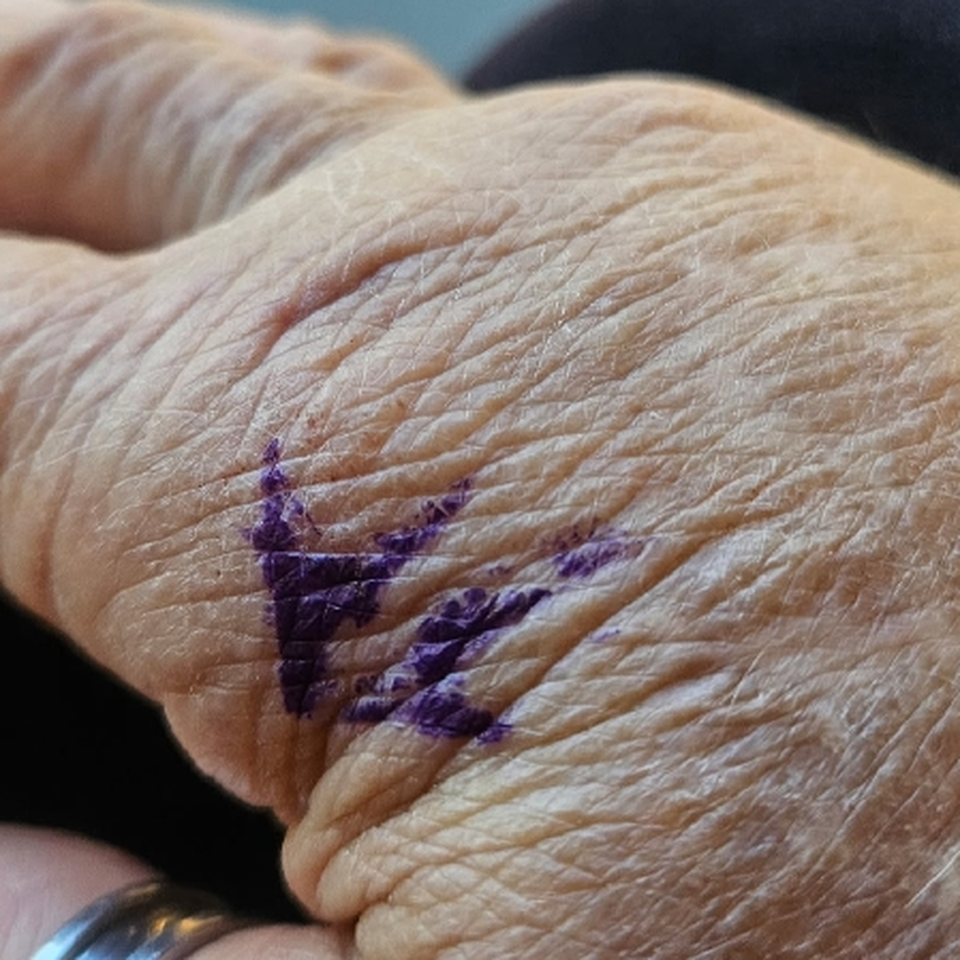 Help Anna Temple Recover from Elbow Surgery