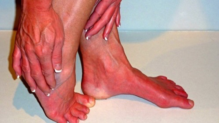 Support Kimberly's Fight Against Erythromelalgia campaign photo, 1 of 7