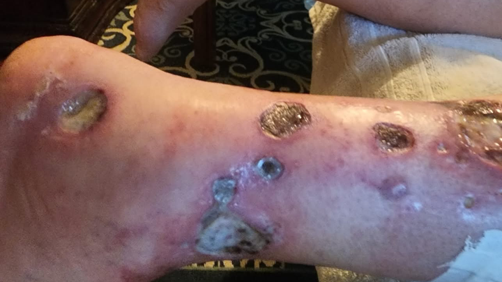 Support Sam's Healing Journey After Spider Bite campaign photo, 1 of 6
