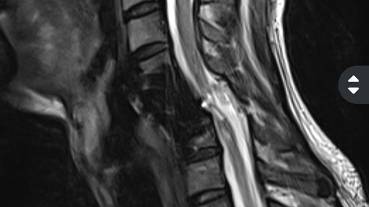 Operación para fractura de cuello