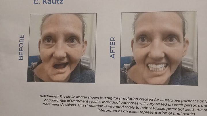Help Carey Get Dental Implants campaign photo, 1 of 3