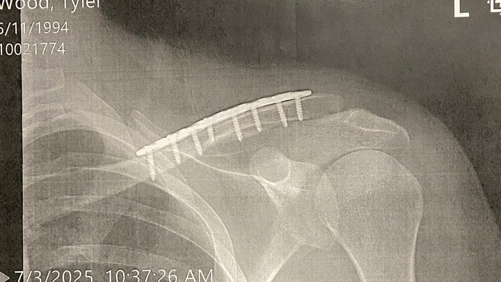 Tyler Broke His Collarbone and Needs Some Help campaign photo, 1 of 8