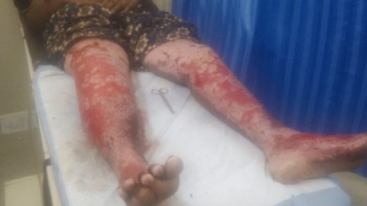 Help My Mom, Rukmini Recover From Devastating Burn Accident campaign photo, 1 of 4