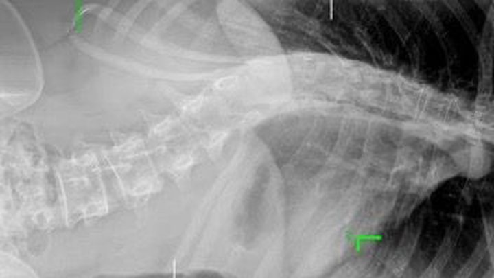 Help Ya Fatou Undergo spinal surgery campaign photo, 1 of 3