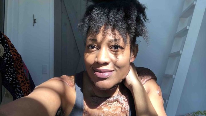 Jonelle’s Keloid Removal Surgeries campaign photo, 1 of 3