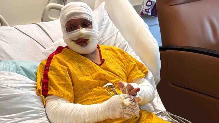 Support Fabian’s Recovery After the Fire campaign photo, 1 of 5