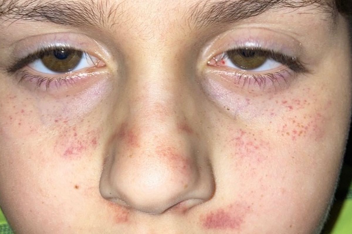 0-result-images-of-purple-spots-on-face-after-vomiting-png-image