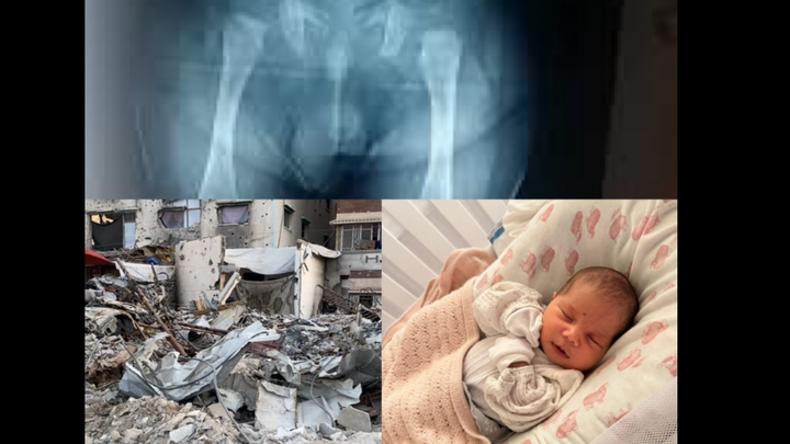 Help Orphan Baby in Urgent Need Surgery to walk normally campaign photo, 1 of 4