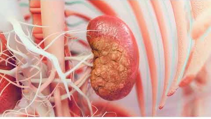 Urgent Kidney Transplant Fundraiser for Ronald Cruz video thumbnail, 1 of 4