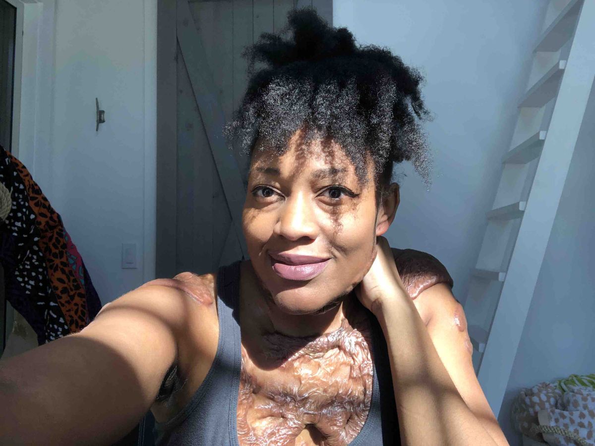 Jonelle’s Keloid Removal Surgeries campaign photo, 1 of 3