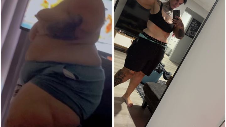 130kg Down. One Final Step: Skin Removal Surgery ❤️✂️ campaign photo, 1 of 8