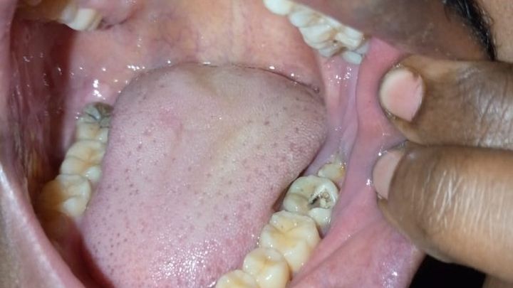 Help Me Restore My Smile, Oral Health, & Relieve Dental pain campaign photo, 1 of 4