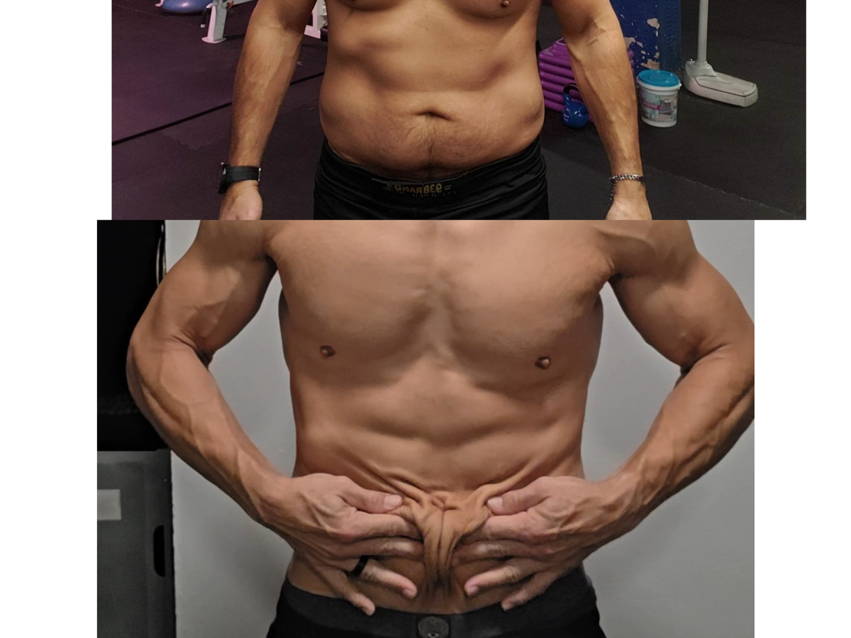 Victor's skin removal surgery campaign photo, 1 of 7