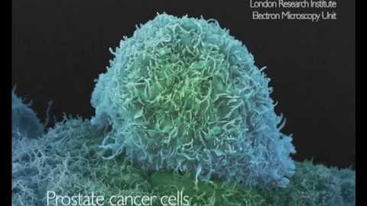 RUNNING 20K A WEEK TO RAISE MONEY FOR CANCER RESEARCH UK video thumbnail, 1 of 3