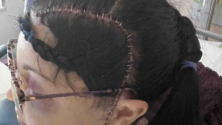 Briana's brain tumour removal recovery campaign photo, 1 of 4