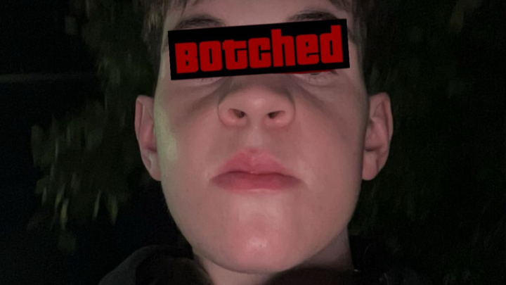 Botched Jaw Surgery revision campaign photo, 1 of 6