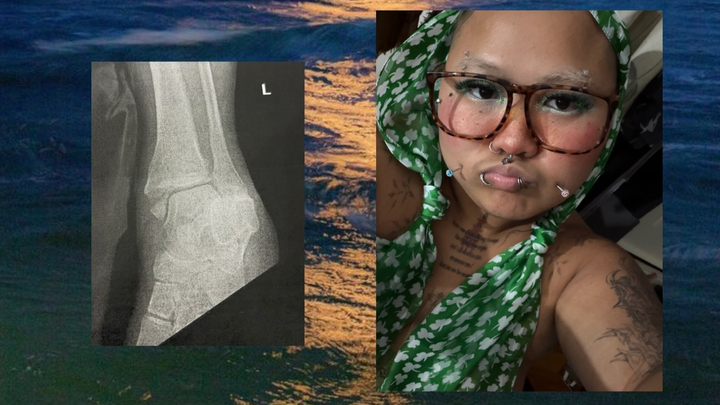 Cover Lux's Surgery and Lost Income After Leg Break campaign photo, 1 of 4