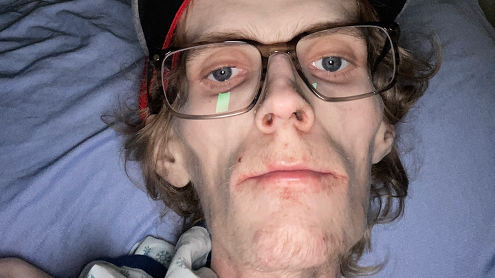 Help Austin Heal, Recover, and Rebuild After Surgery campaign photo, 1 of 4