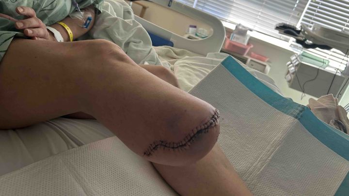 Support Recovery After Amputation campaign photo, 1 of 5