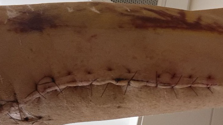 Support After Severe Arm Injury and Surgeries campaign photo, 1 of 8