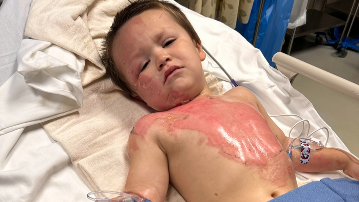 Lyle Roger's Burn Recovery campaign photo, 1 of 6