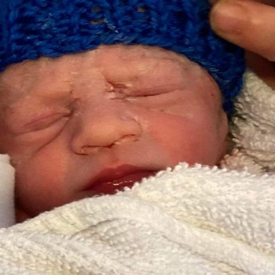 Why Are Stillborn Babies Lips Black