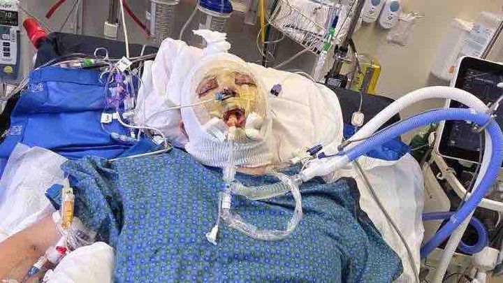 Support Kc's Healing Journey After Burn Accident campaign photo, 1 of 10