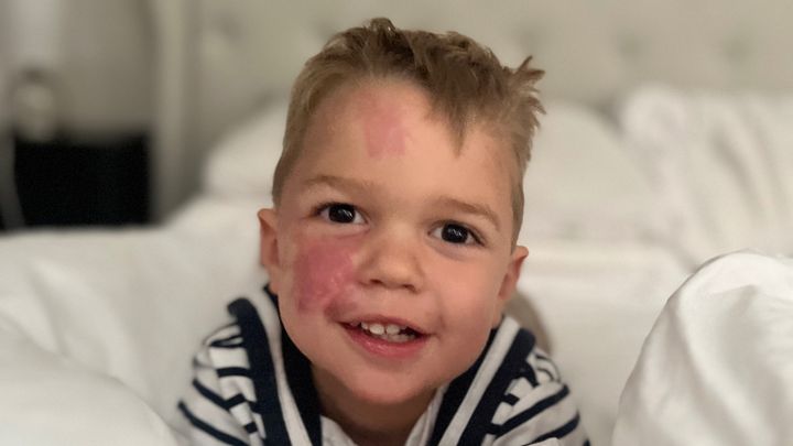Help Fund a Future Cure for Sturge-Weber Syndrome campaign photo, 1 of 7