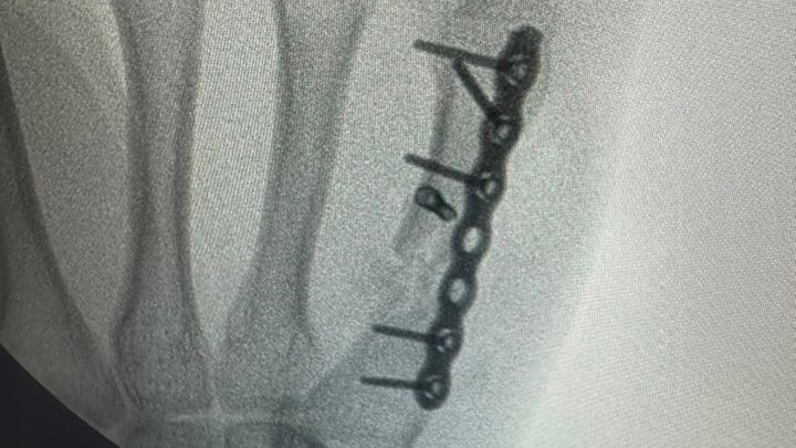Broken paw & bone and plate implants . campaign photo, 1 of 7