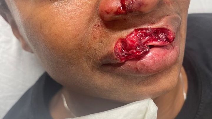 Help me after a traumatic dog bite campaign photo, 1 of 5