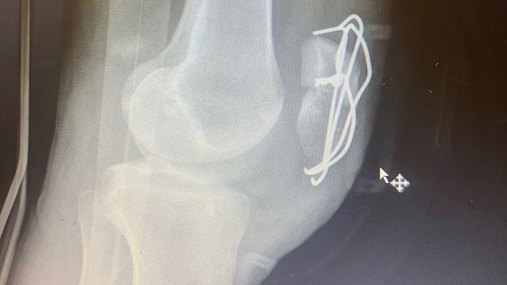 Fractured kneecap recovery… campaign photo, 1 of 8