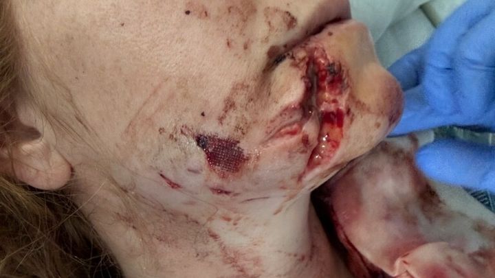 Support Courtenay’s Recovery After Dog Attack campaign photo, 1 of 8