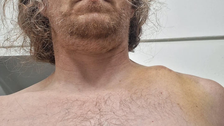 Help Kyle Get Surgery After His Scooter Accident campaign photo, 1 of 8