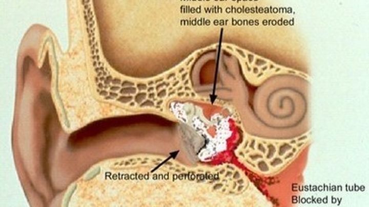 Fundraiser by Lonnie Henderson : Cholesteatoma Surgery Fund