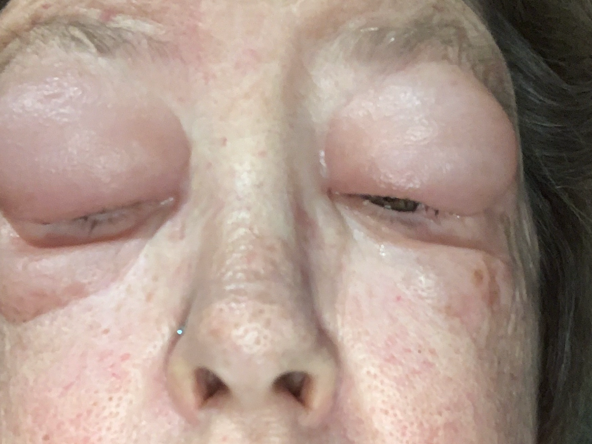 Donate for Cataract Surgery Recovery campaign photo, 1 of 4