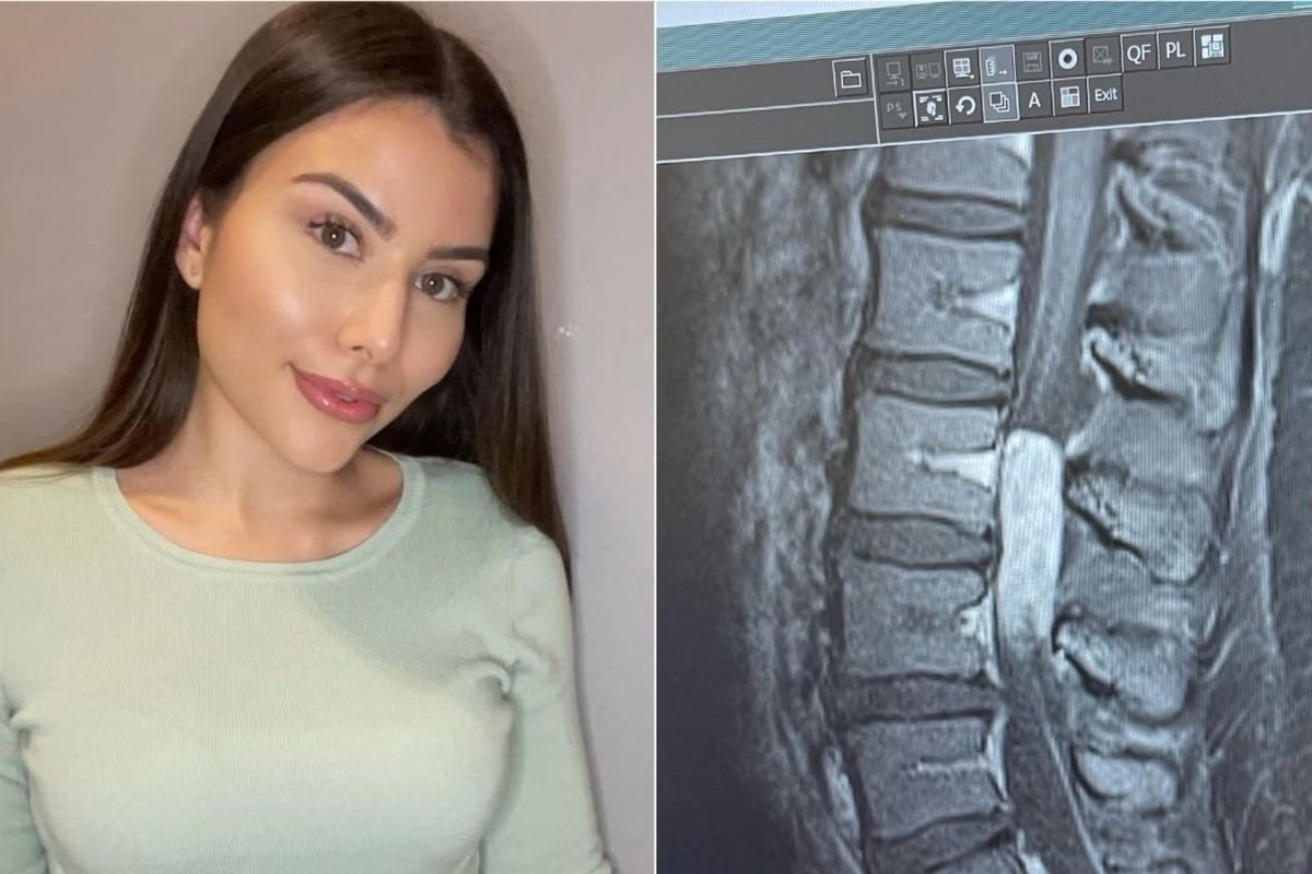 Fundraiser by Denise Brietzke : Dymond's spinal surgery recovery