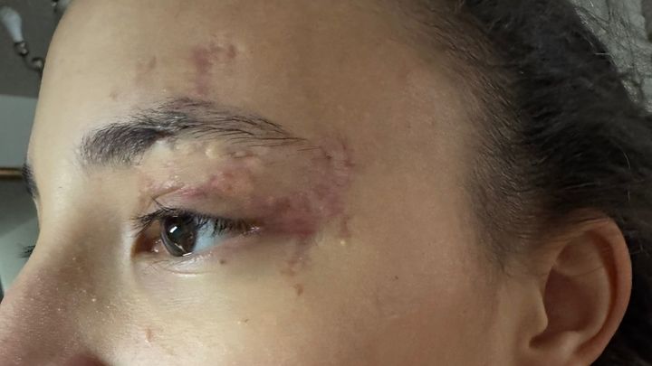 Help My Daughter Heal After Accident campaign photo, 1 of 5