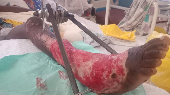 Help Save 6-Year-Old's Life and Leg campaign photo, 1 of 7