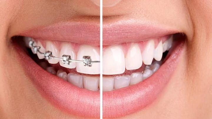 Struggling with Braces Cost as an Adult, pls help campaign photo, 1 of 3